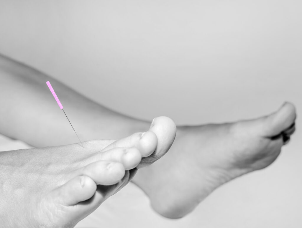 Acupuncture at Axis Natural Medicine in Fort Myers, FL